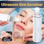 Espátula Ultrasónica Limpiadora Facial | Elimina Puntos Negros y Poros